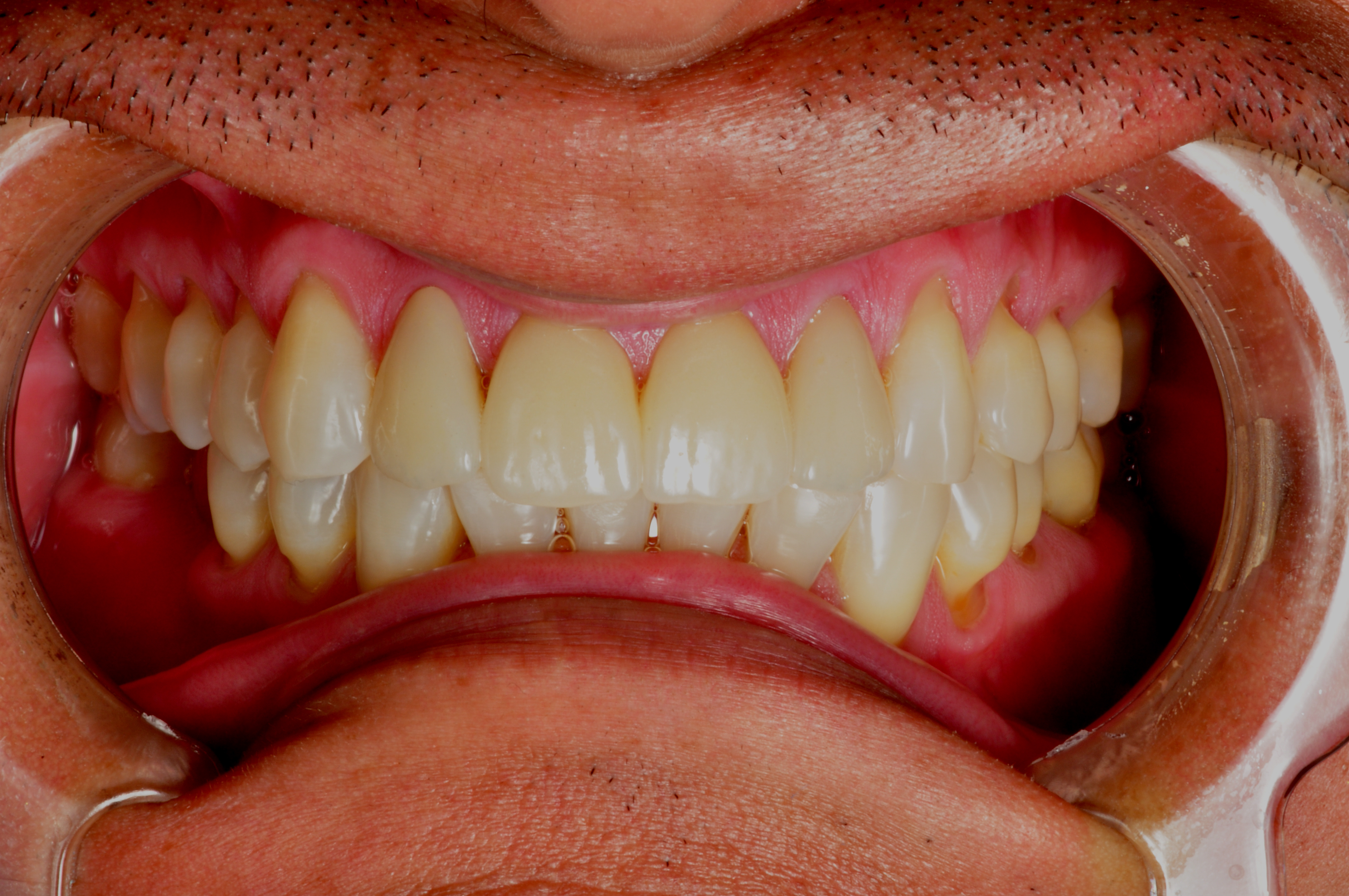 Nicolas After Crowns & Veneers